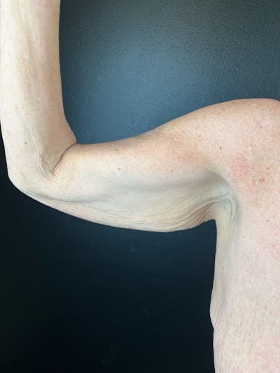 Arm Lift Before & After Gallery - Patient 174459 - Image 1