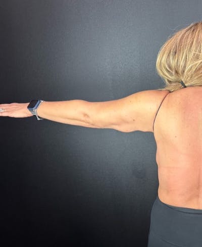 Arm Lift Before & After Gallery - Patient 180666 - Image 2
