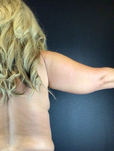 Arm Lift Before & After Gallery - Patient 180666 - Image 1
