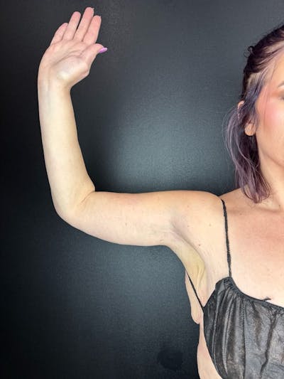 Arm Lift Before & After Gallery - Patient 568338 - Image 2