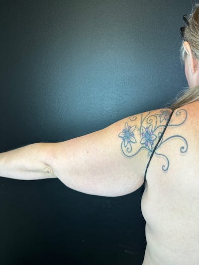 Arm Lift Before & After Gallery - Patient 162627 - Image 1
