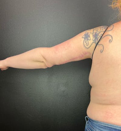 Arm Lift Before & After Gallery - Patient 162627 - Image 2
