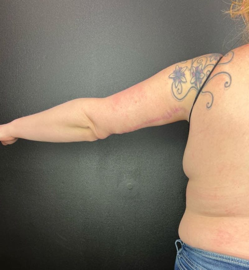 Arm Lift Before & After Gallery - Patient 162627 - Image 2