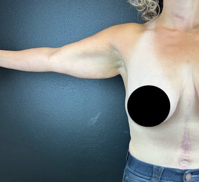 Arm Lift Before & After Gallery - Patient 391626 - Image 1