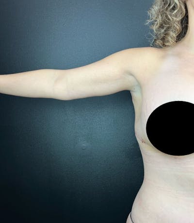 Arm Lift Before & After Gallery - Patient 391626 - Image 2