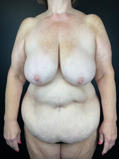 Tummy Tuck Before & After Gallery - Patient 292786 - Image 1
