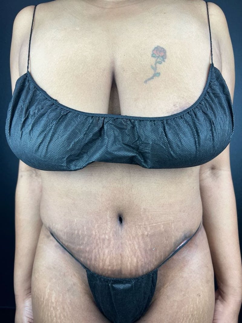 Tummy Tuck Before & After Gallery - Patient 111300 - Image 4
