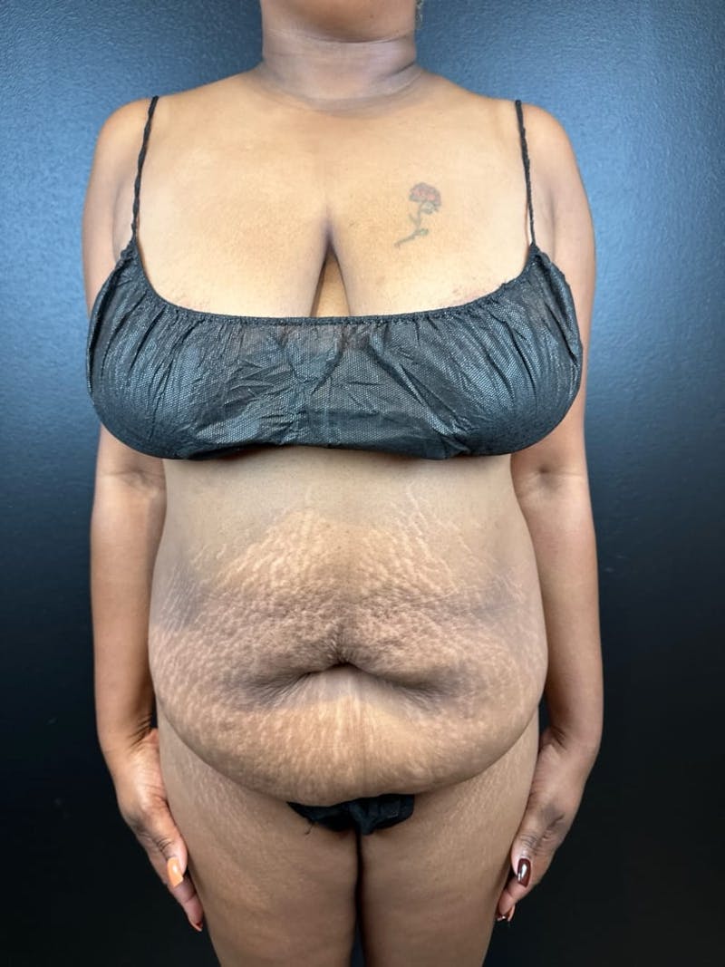 Tummy Tuck Before & After Gallery - Patient 111300 - Image 3