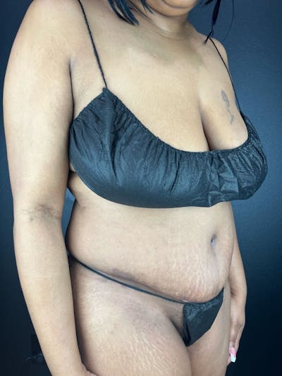 Tummy Tuck Before & After Gallery - Patient 111300 - Image 2
