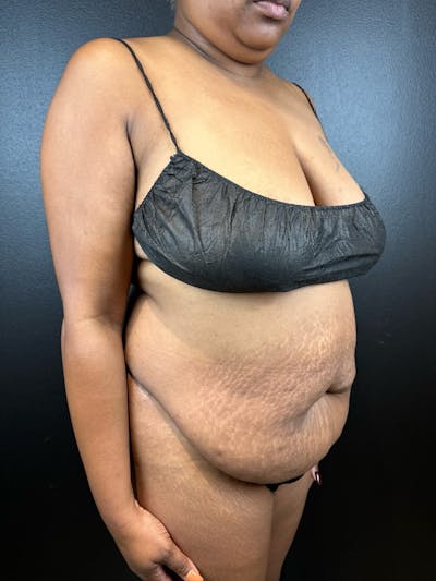 Tummy Tuck Before & After Gallery - Patient 111300 - Image 1