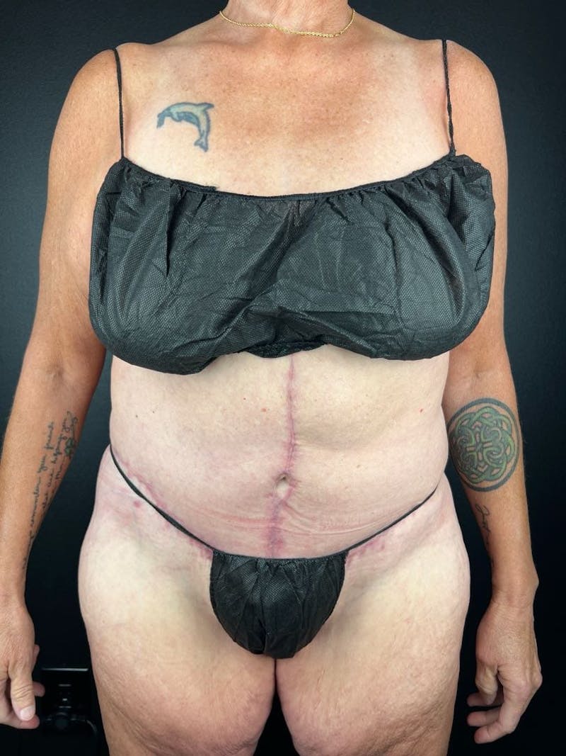 Tummy Tuck Before & After Gallery - Patient 716513 - Image 4