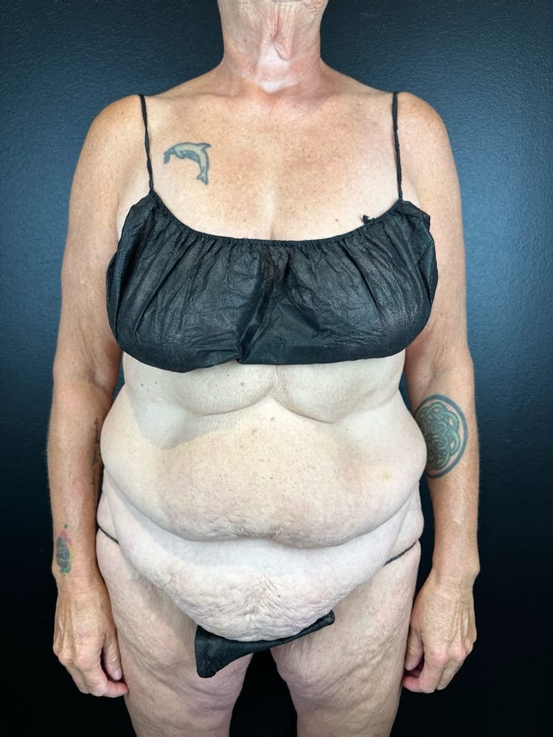 Tummy Tuck Before & After Gallery - Patient 716513 - Image 3