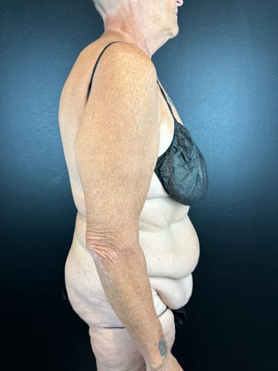 Tummy Tuck Before & After Gallery - Patient 716513 - Image 1