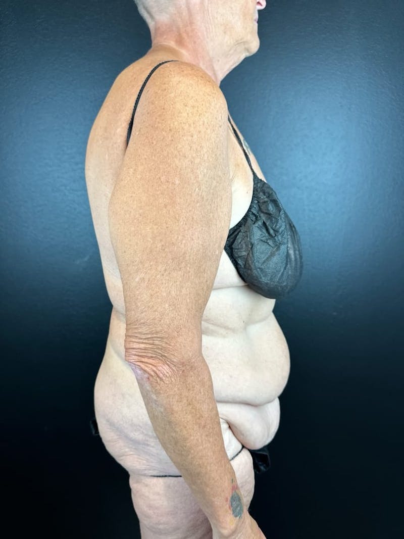 Tummy Tuck Before & After Gallery - Patient 716513 - Image 1