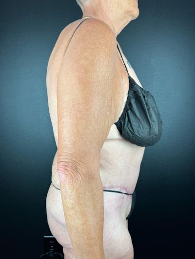 Tummy Tuck Before & After Gallery - Patient 716513 - Image 2