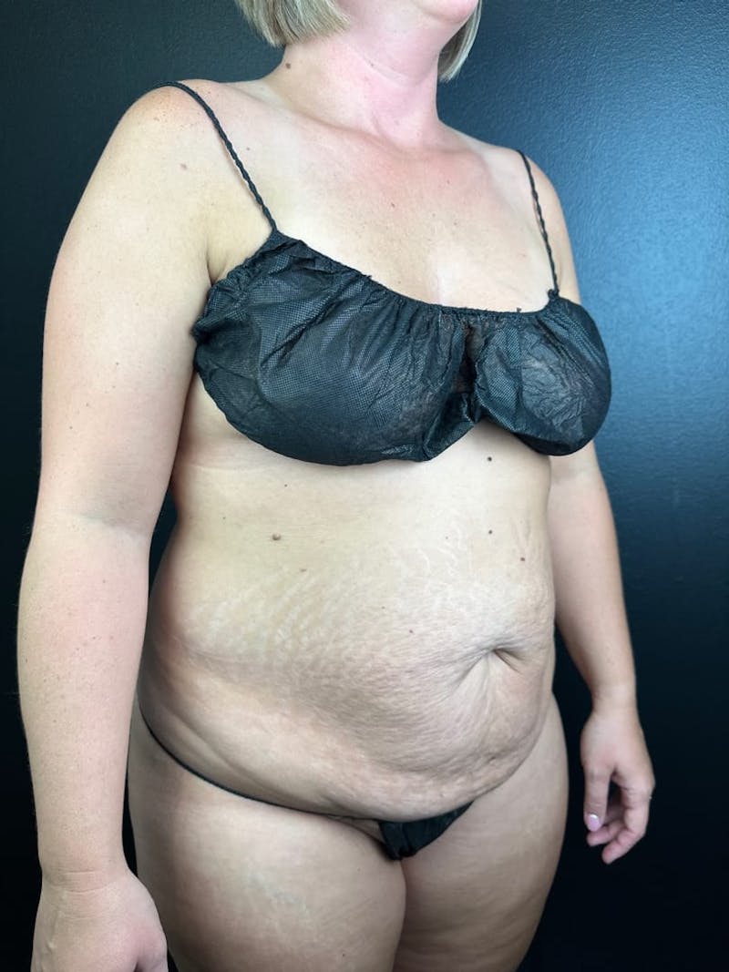 Tummy Tuck Before & After Gallery - Patient 807161 - Image 1