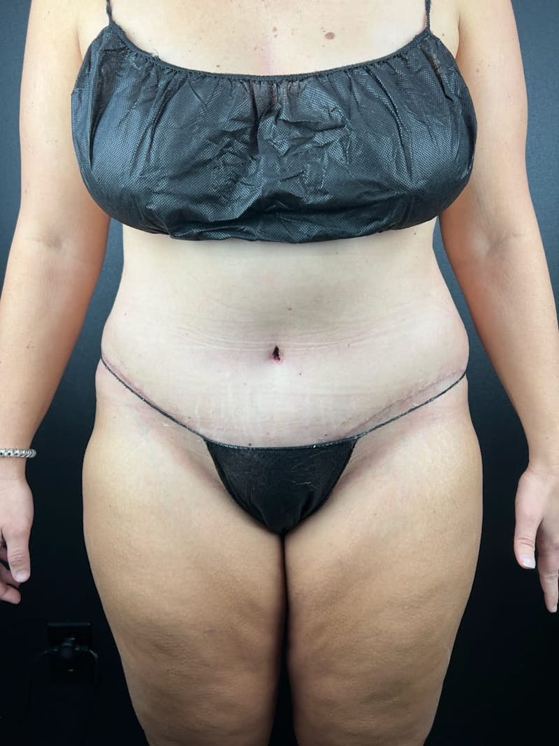 Tummy Tuck Before & After Gallery - Patient 582664 - Image 4