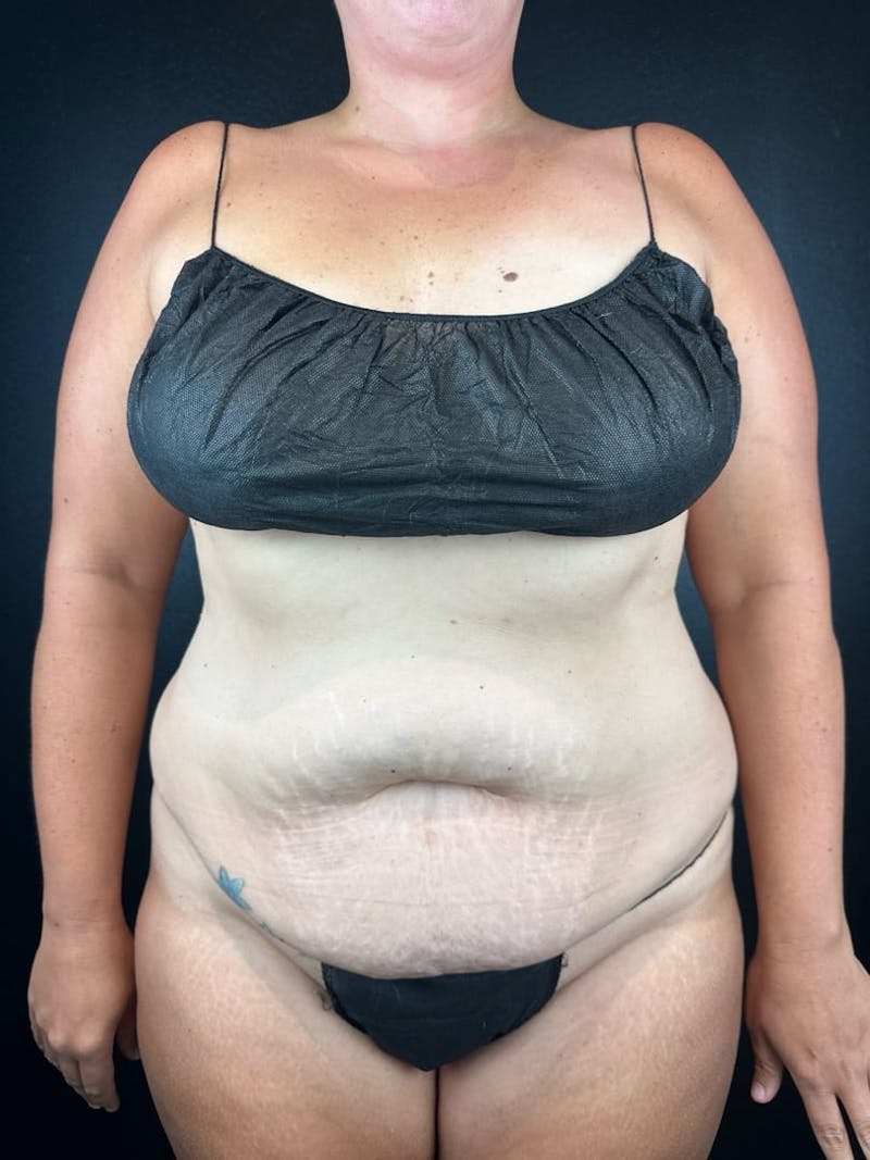 Tummy Tuck Before & After Gallery - Patient 582664 - Image 3