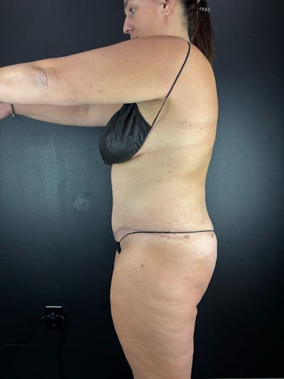 Tummy Tuck Before & After Gallery - Patient 582664 - Image 2