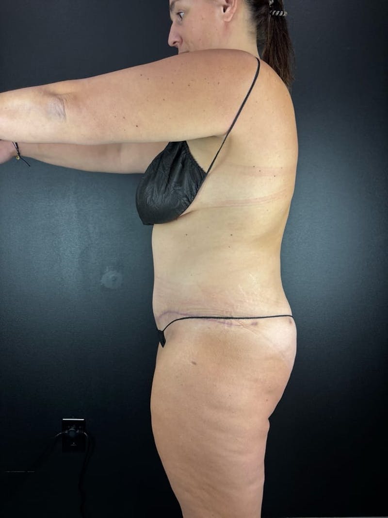 Tummy Tuck Before & After Gallery - Patient 582664 - Image 2