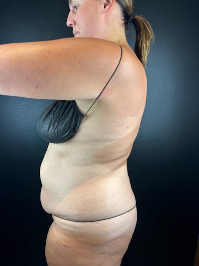 Tummy Tuck Before & After Gallery - Patient 582664 - Image 1