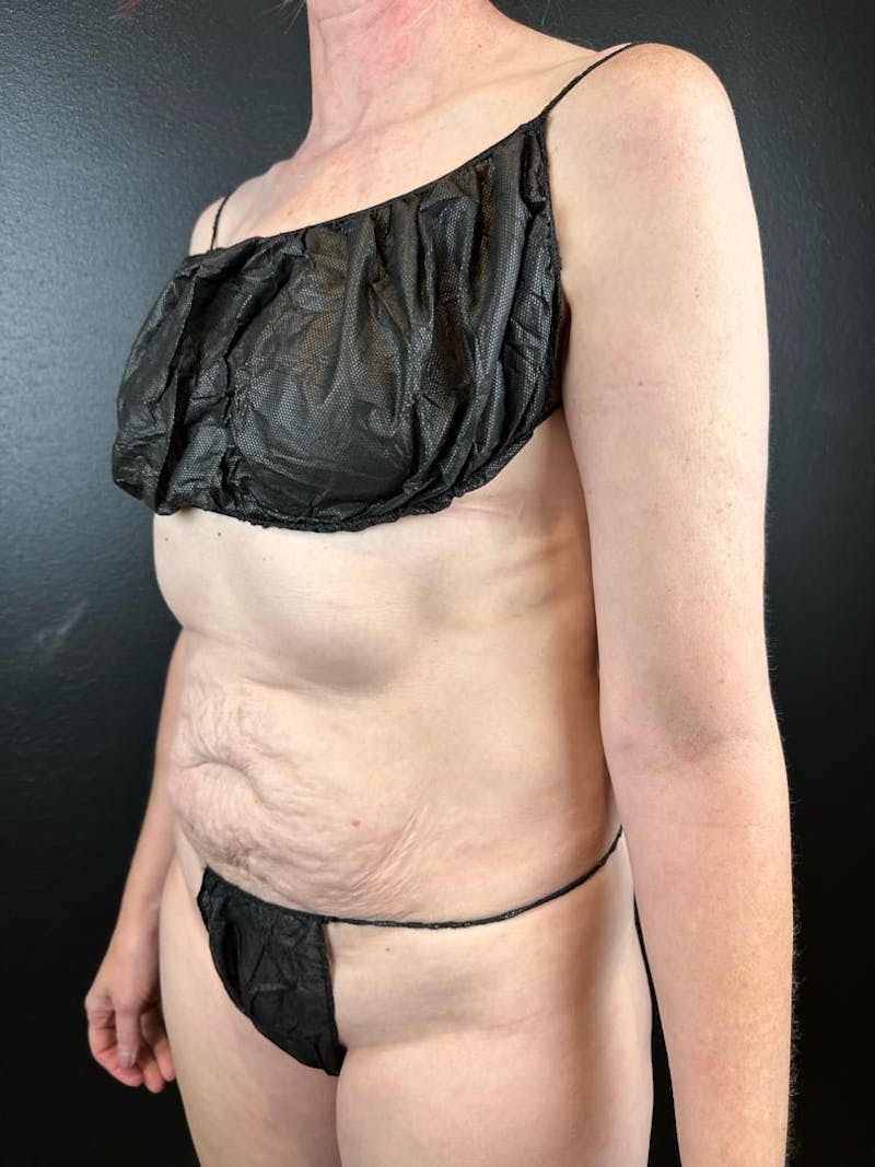 Tummy Tuck Before & After Gallery - Patient 794493 - Image 1