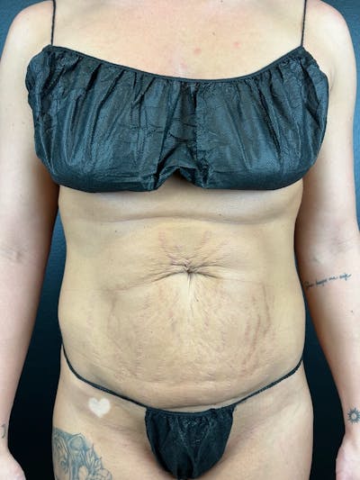 Tummy Tuck Before & After Gallery - Patient 393520 - Image 1