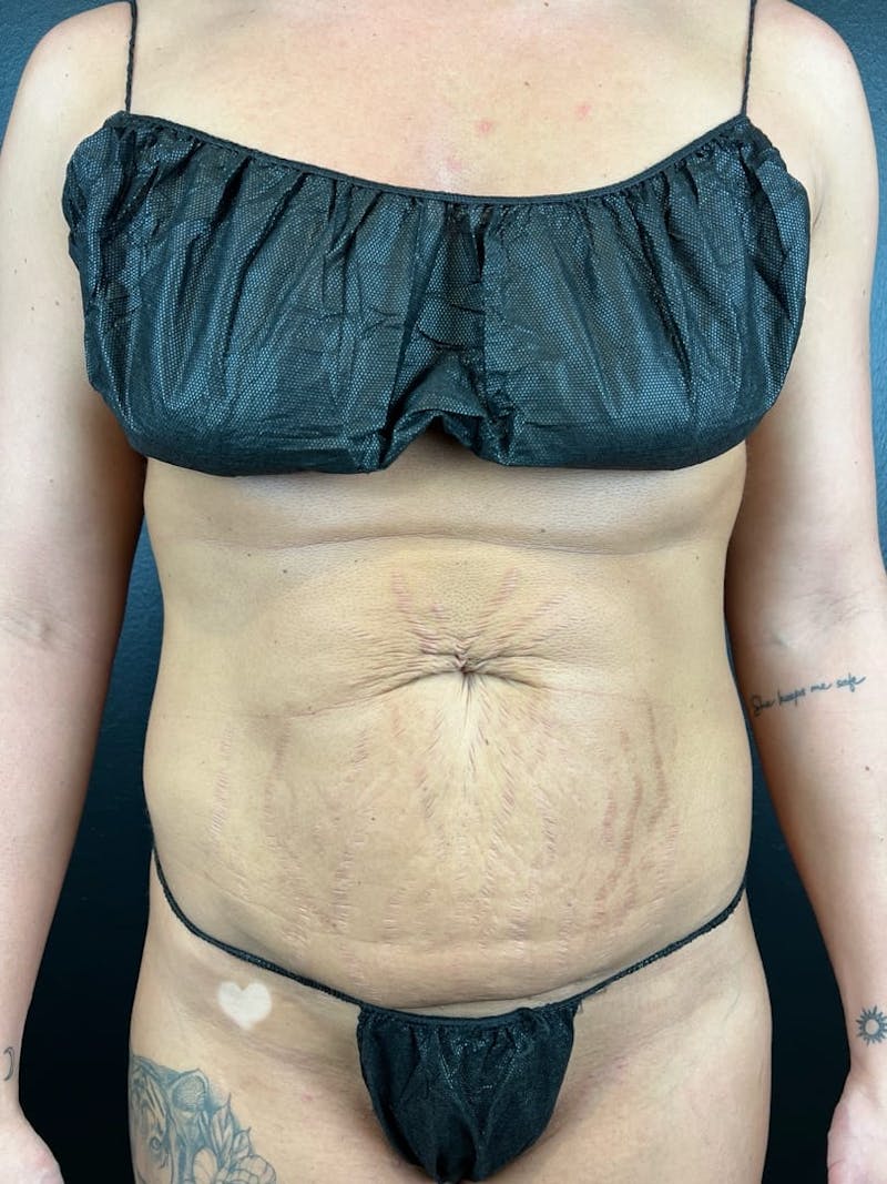 Tummy Tuck Before & After Gallery - Patient 393520 - Image 1
