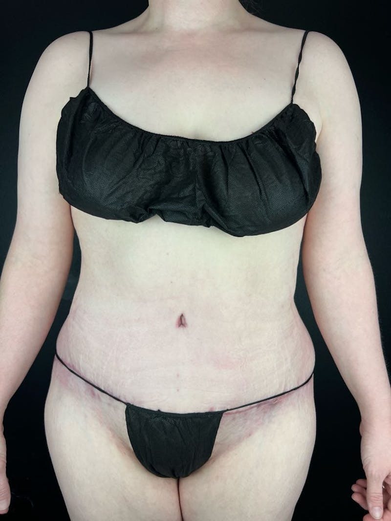 Tummy Tuck Before & After Gallery - Patient 663126 - Image 4