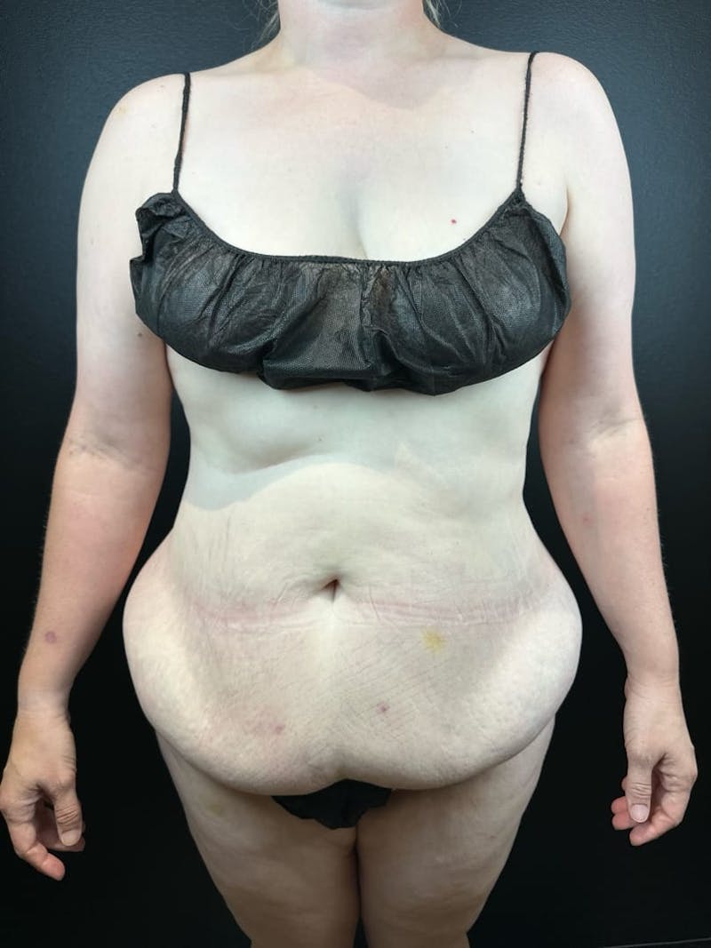 Tummy Tuck Before & After Gallery - Patient 663126 - Image 3