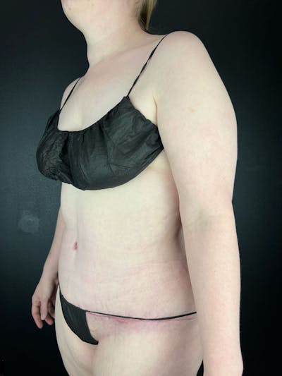 Tummy Tuck Before & After Gallery - Patient 663126 - Image 2