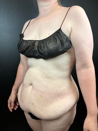 Tummy Tuck Before & After Gallery - Patient 663126 - Image 1