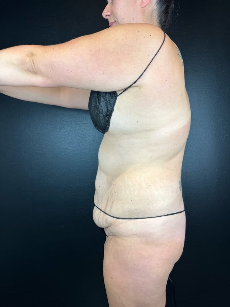 Tummy Tuck Before & After Gallery - Patient 123893 - Image 1