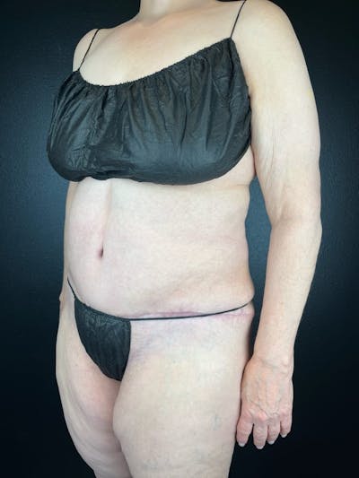 Tummy Tuck Before & After Gallery - Patient 407317 - Image 2