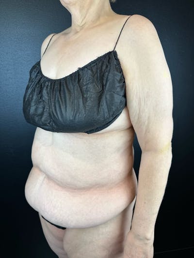 Tummy Tuck Before & After Gallery - Patient 407317 - Image 1