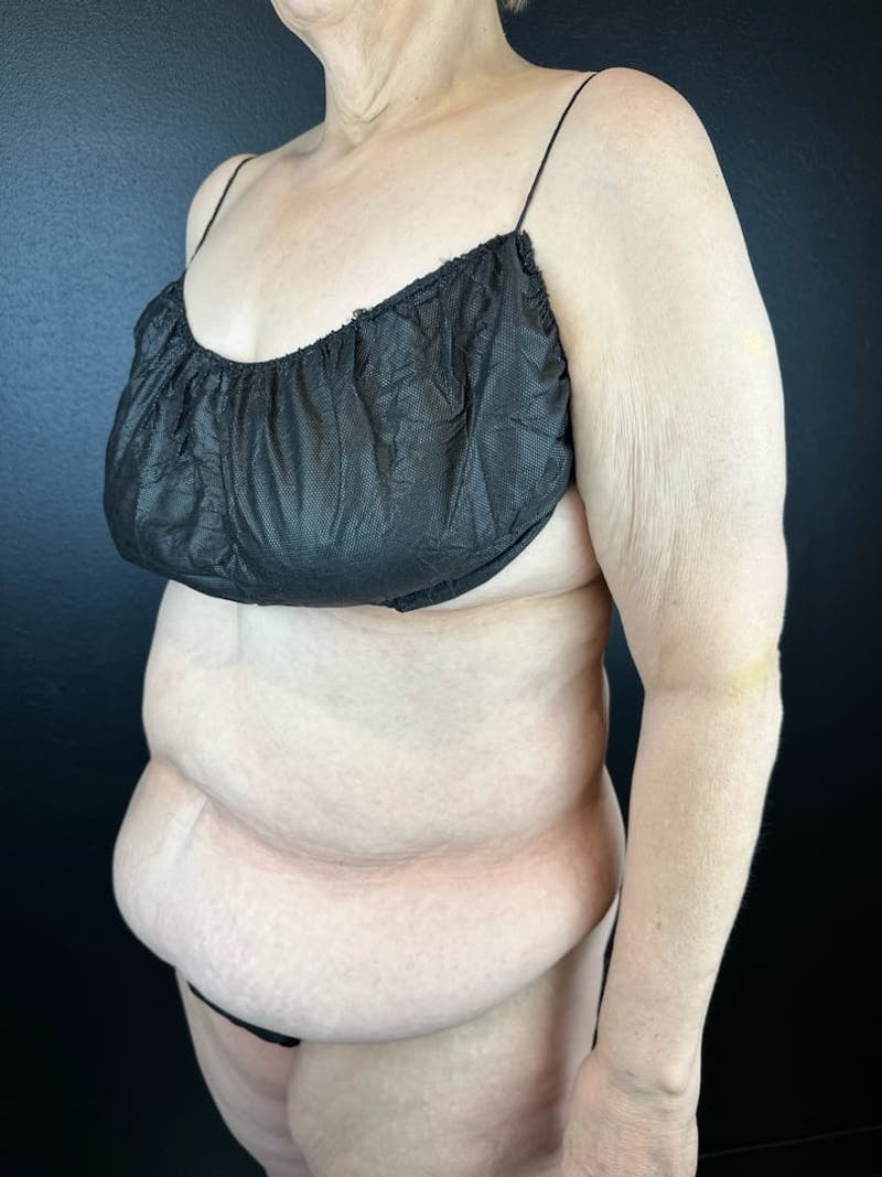 Tummy Tuck Before & After Gallery - Patient 407317 - Image 1