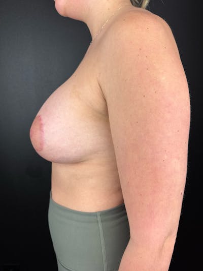 Breast Augmentation Before & After Gallery - Patient 397250 - Image 2