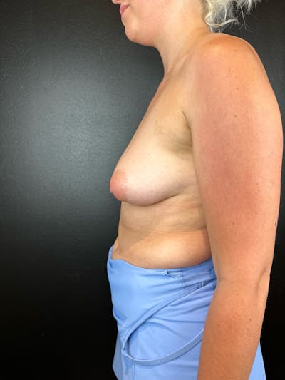 Breast Augmentation Before & After Gallery - Patient 397250 - Image 1