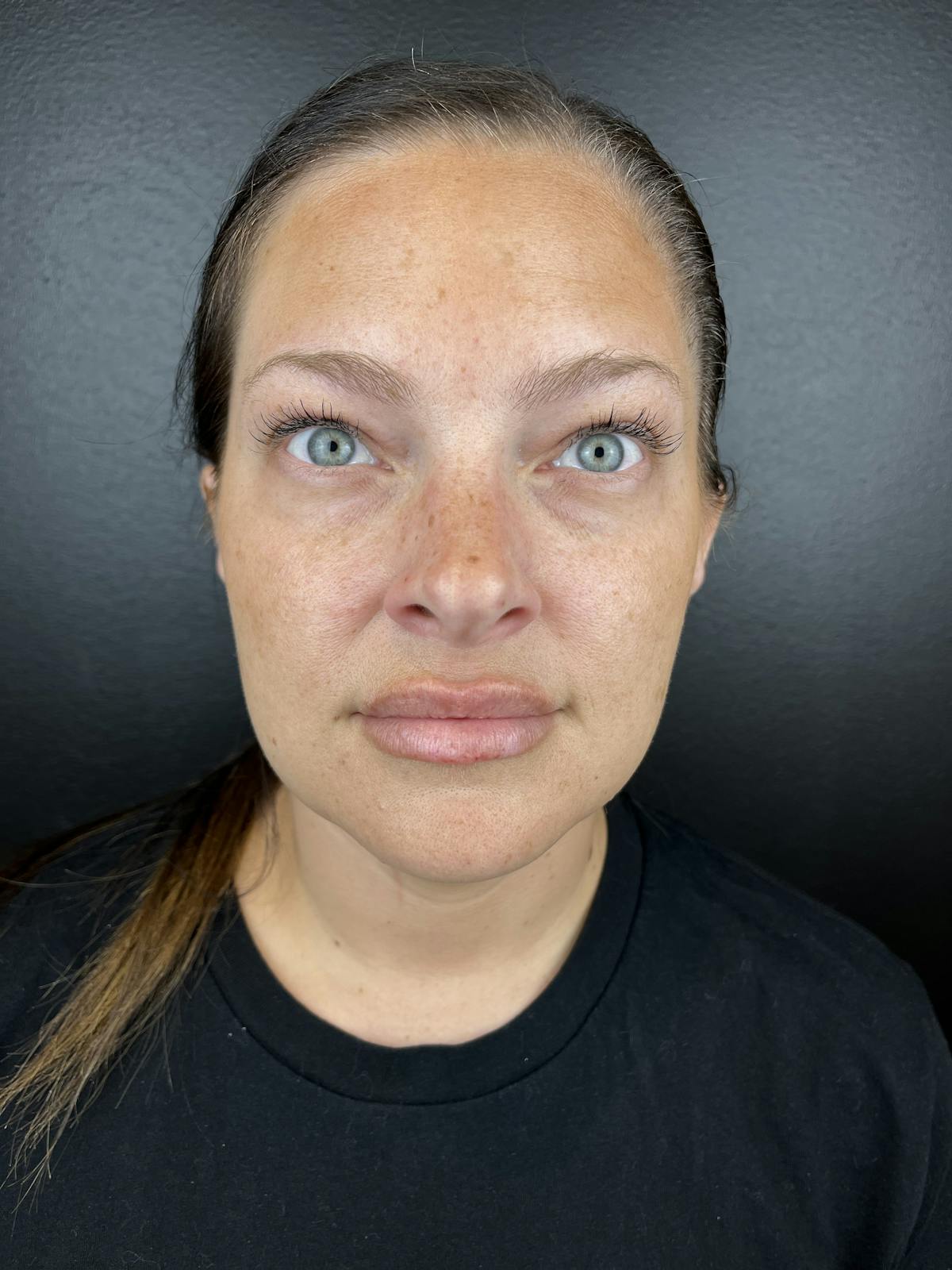 Wrinkle Relaxer Before & After Gallery - Patient 100019 - Image 2