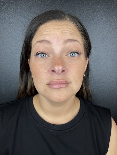 Wrinkle Relaxer Before & After Gallery - Patient 100019 - Image 1