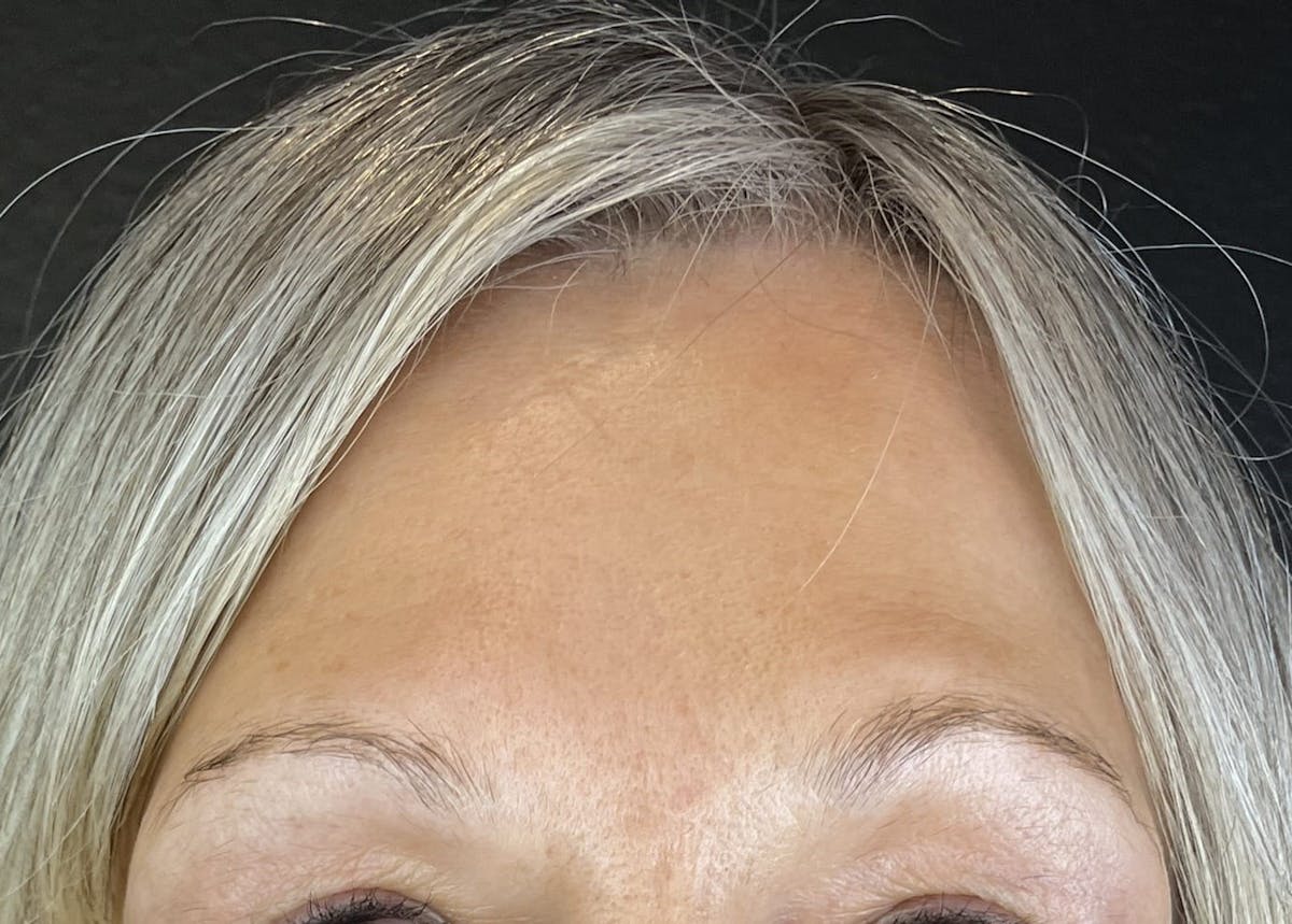 Wrinkle Relaxer Before & After Gallery - Patient 613392 - Image 2