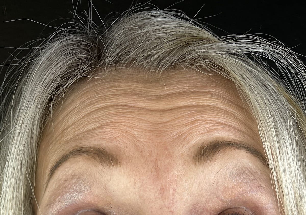 Wrinkle Relaxer Before & After Gallery - Patient 613392 - Image 1