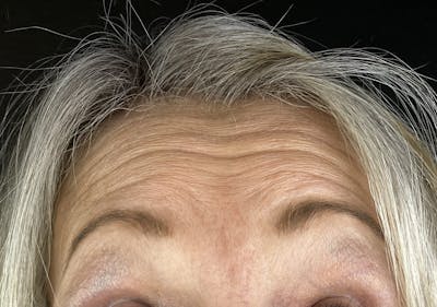 Wrinkle Relaxer Before & After Gallery - Patient 613392 - Image 1