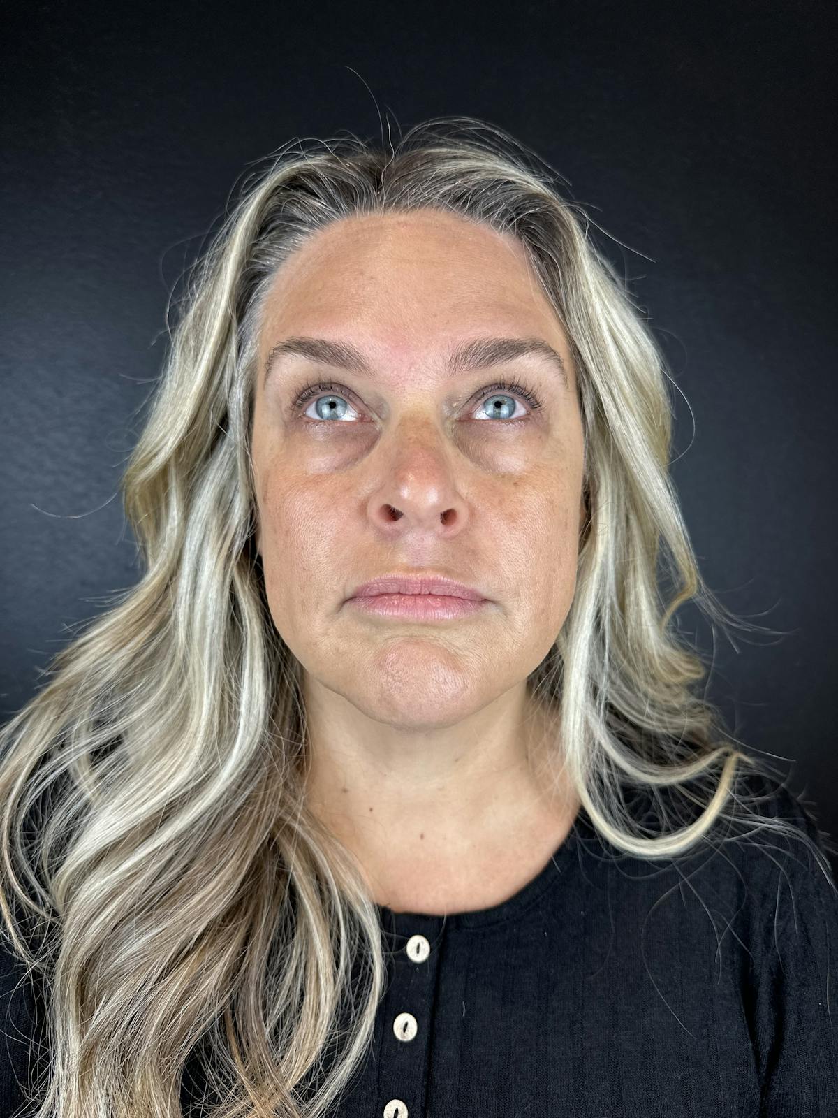 Wrinkle Relaxer Before & After Gallery - Patient 241527 - Image 2