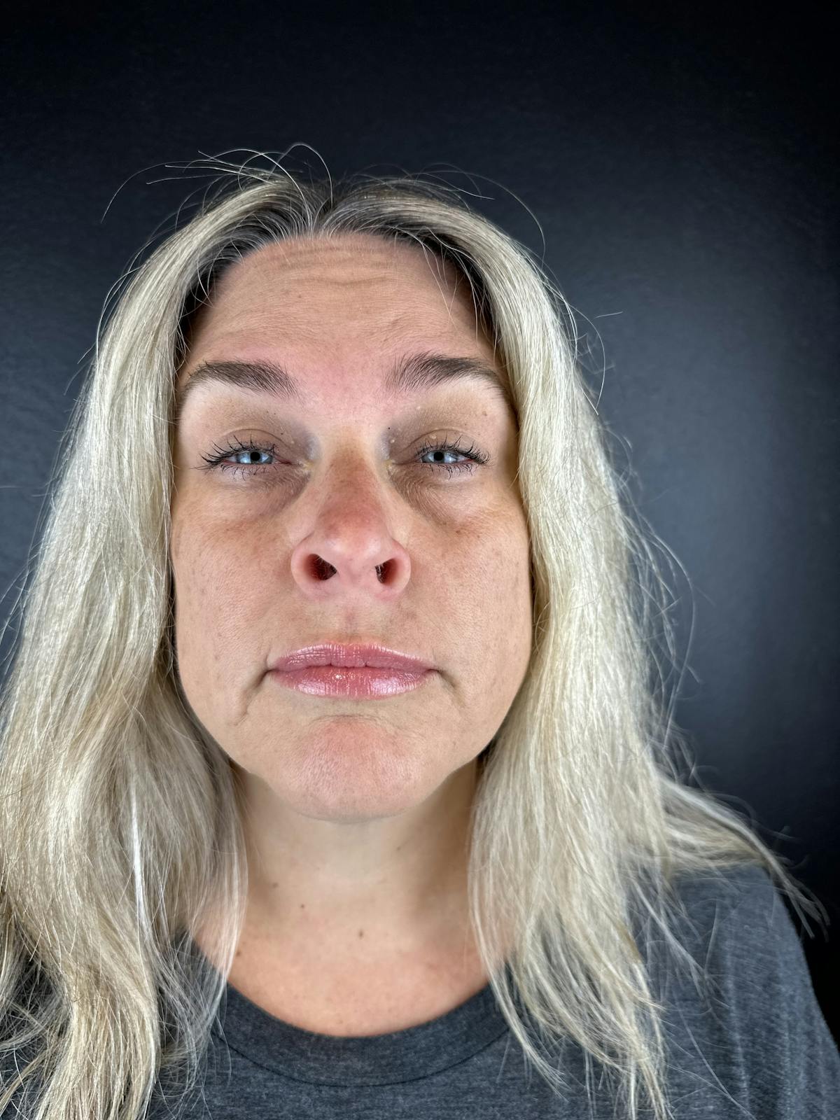 Wrinkle Relaxer Before & After Gallery - Patient 241527 - Image 1