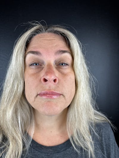 Wrinkle Relaxer Before & After Gallery - Patient 241527 - Image 1