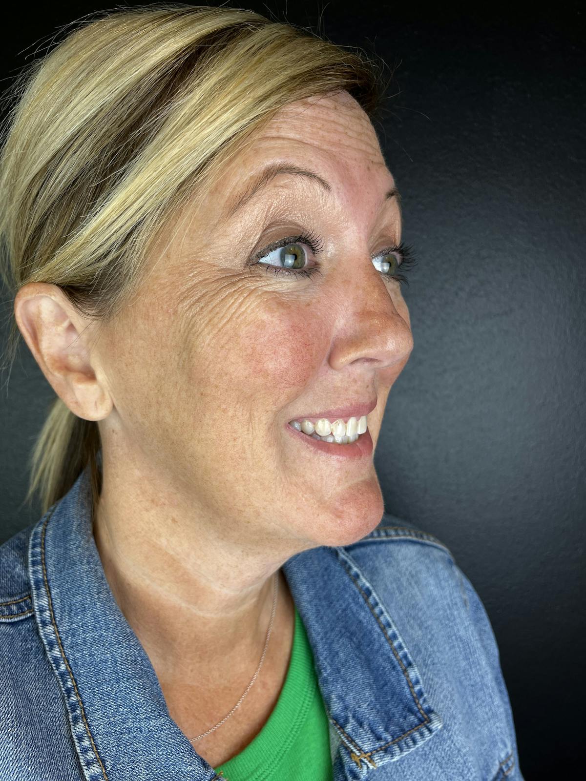 Wrinkle Relaxer Before & After Gallery - Patient 616164 - Image 1
