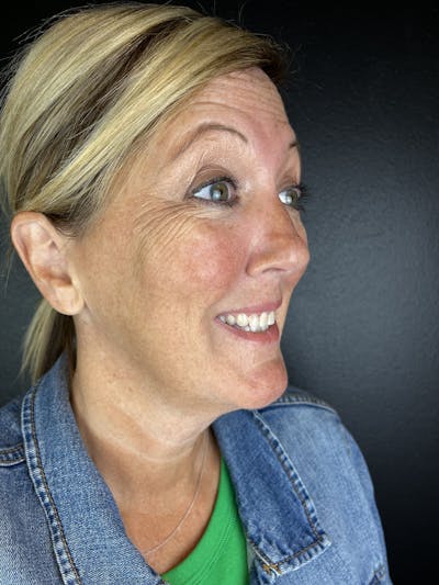 Wrinkle Relaxer Before & After Gallery - Patient 616164 - Image 1