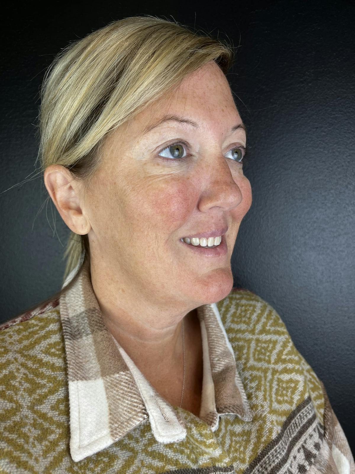Wrinkle Relaxer Before & After Gallery - Patient 616164 - Image 2