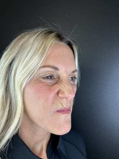 Wrinkle Relaxer Before & After Gallery - Patient 372388 - Image 1